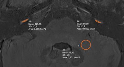 Hydropic Ear Disease: Correlation Between Audiovestibular Symptoms, Endolymphatic Hydrops and Blood-Labyrinth Barrier Impairment